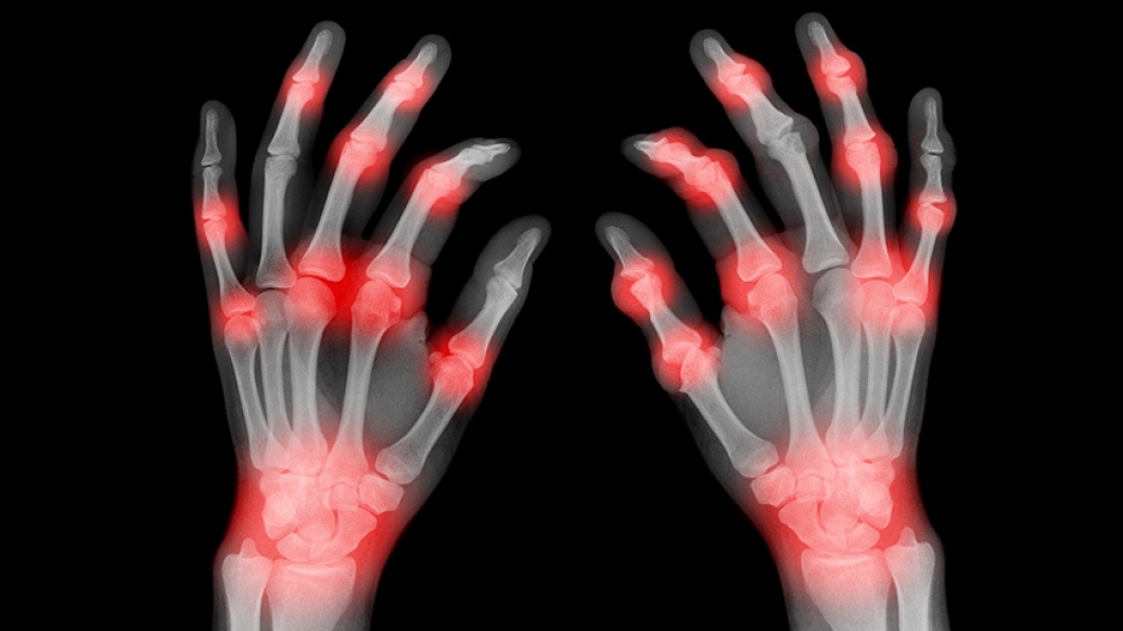 hands of xray finfers with red spots