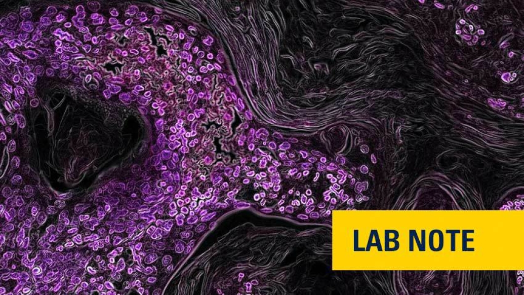 cancer cell in lung that's purple in microscopic view