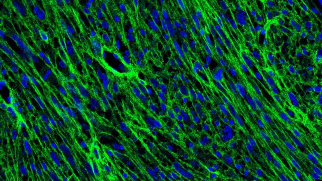 microscopic collagen tumor green blue