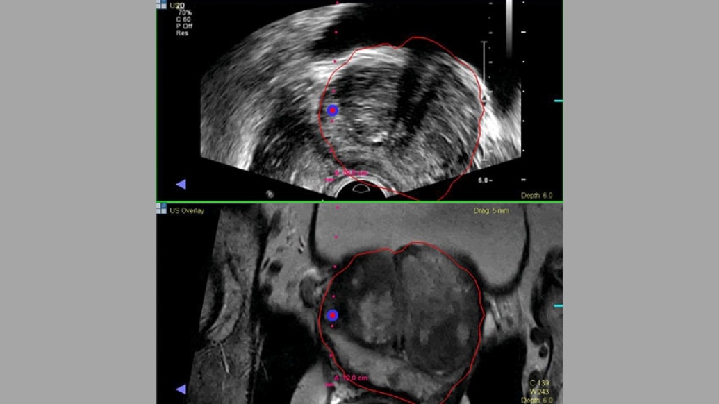 Prostate Cancer Biopsy