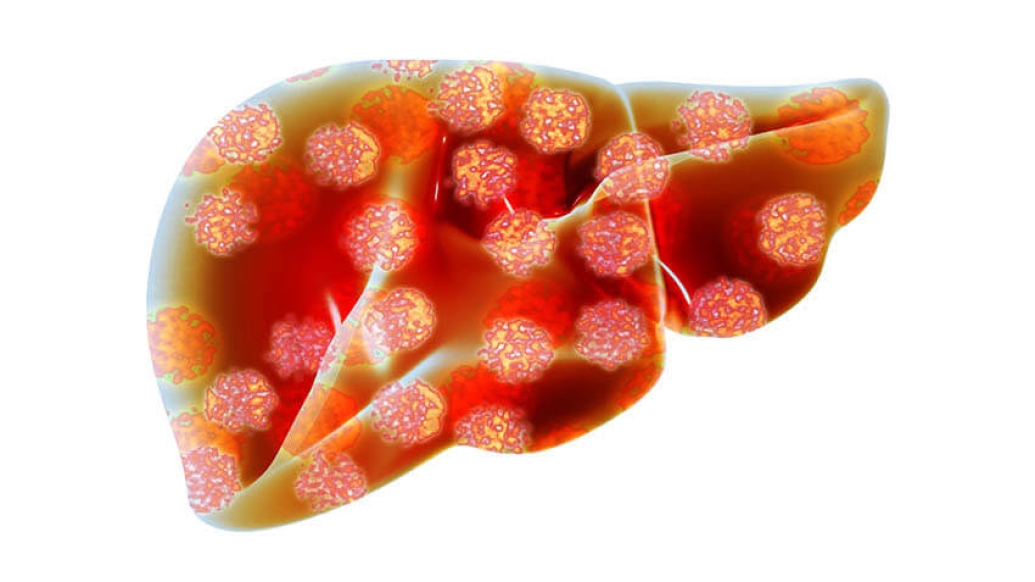 Liver with hepatitis viruses