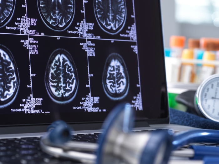 stethoscope laying on a laptop that is displaying a brain scan