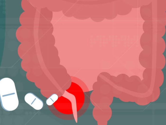 Appendicitis treated with antibiotics