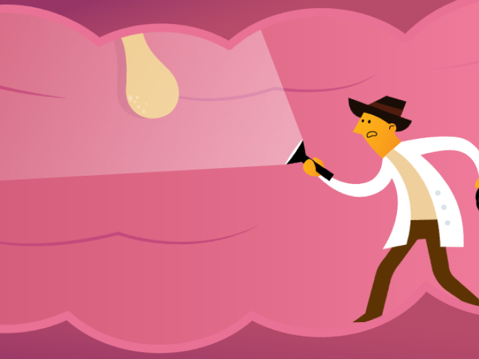 doctor in colon with flashlight and polyp