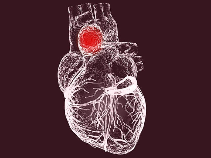 Heart model aneurysm aorta veins