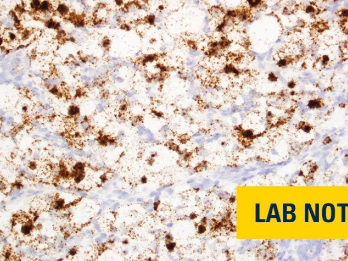 kidney cancer microscopic gene biomarker image with words "lab note" in bottom right in yellow and blue font