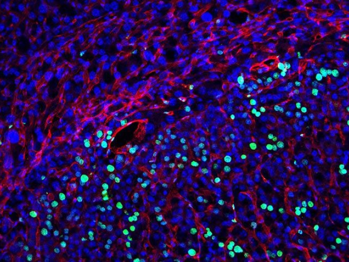 liver cancer cells microscopic cells