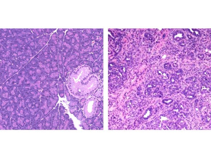 Microscopic slide of purple cancer cells