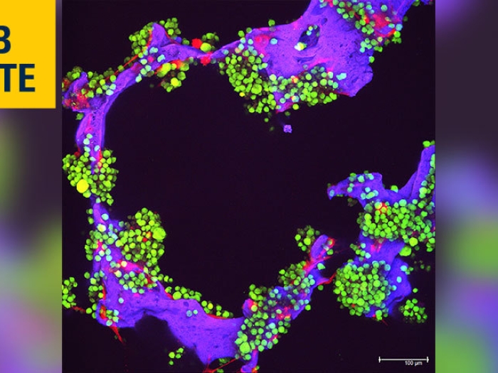 myeloma purple green