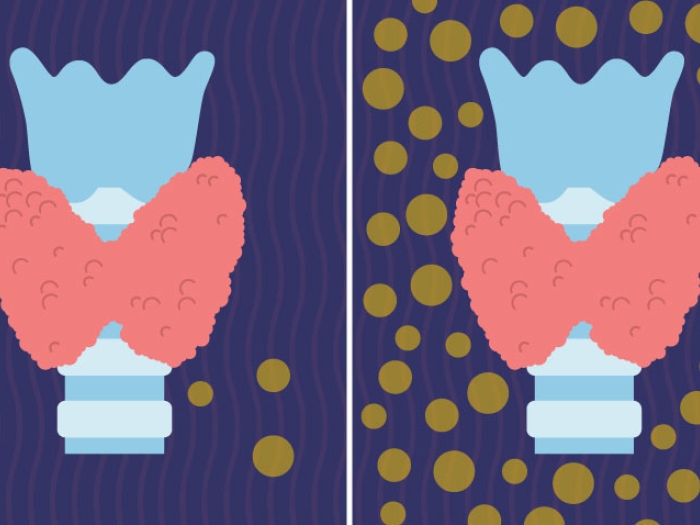 Graphic of thyroid with thyroid disease vs. a healthy thyroid