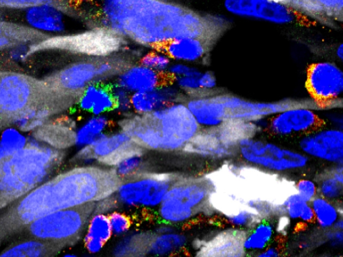 Microscopic image of glioblastoma multiforme