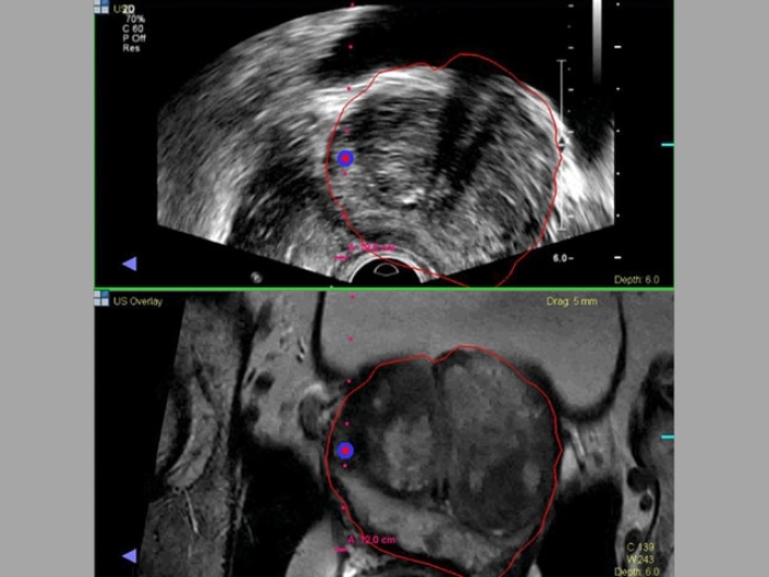 Prostate Cancer Biopsy