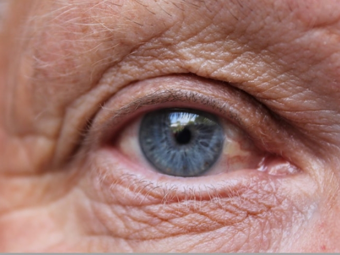 Close up of an eye suffering from wet age related macular degeneration (wet AMD)