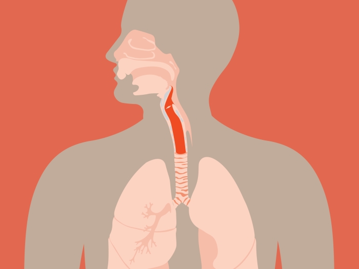 Graphic of laryngeal cancer