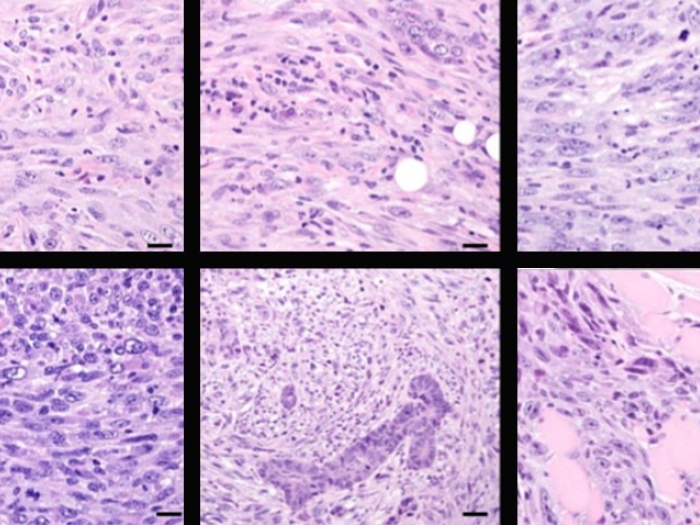 Microscopic images of metaplastic breast cancer cells