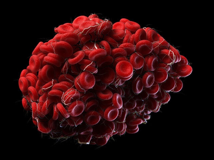 Image of a blood clot