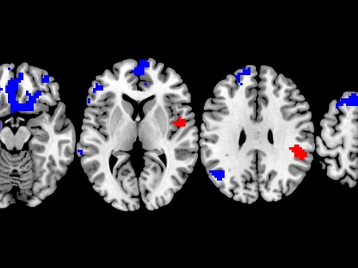 Brain scans of OCD.