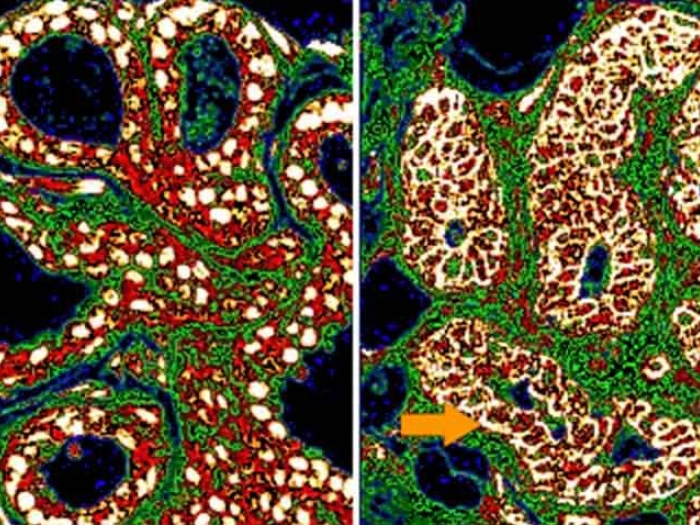 close up of breast cancer cell scan