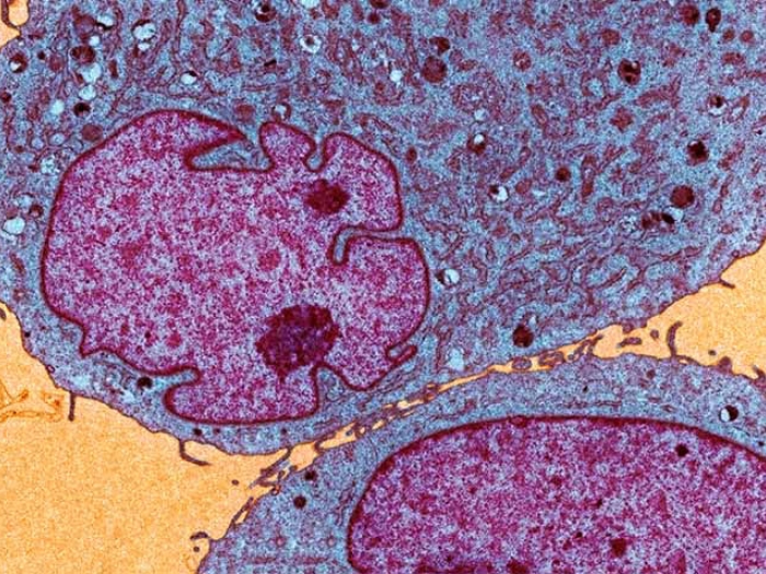 Leukemia_and_lymphoma_tumor_cells