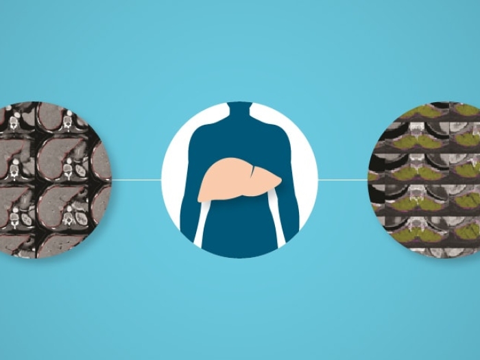 Image of liver scans