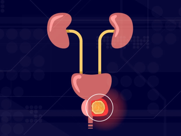 Prostate cancer