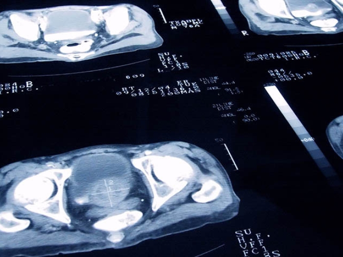 Prostate cancer scans
