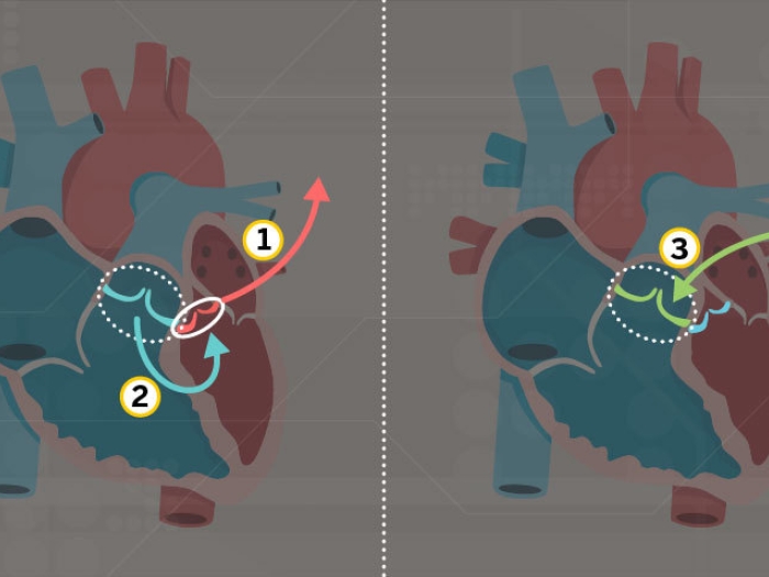 Diagram of the Ross procedure for aortic valve replacement