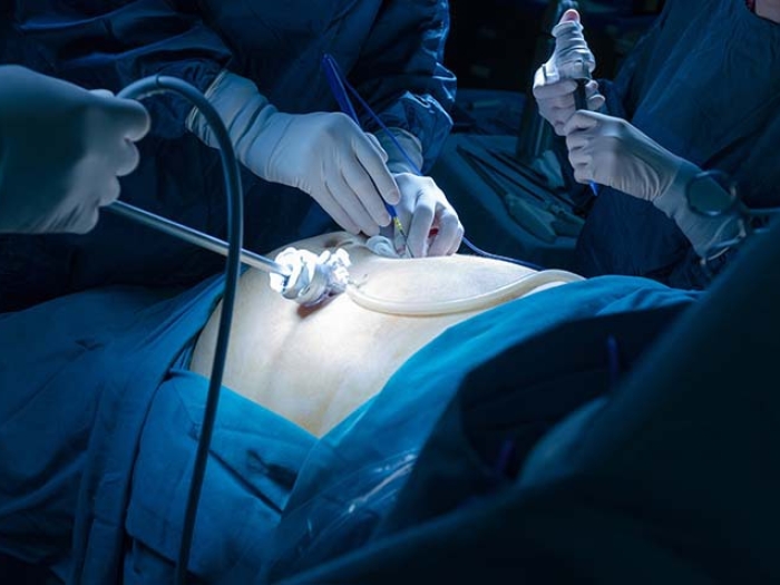 image of surgery happening above stomach with blue surgical drapes with surgical tools with white gloves removing appendix