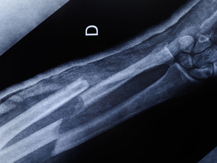Xray of a broken arm